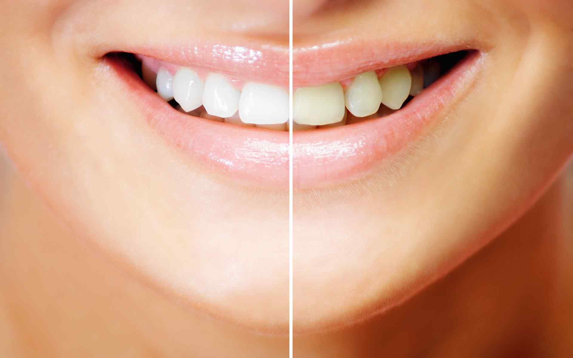 How whitening strips can damage your teeth